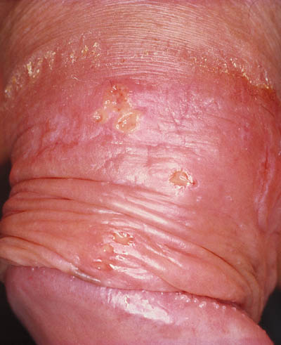Erosioner på penis ved udbrud af herpes
