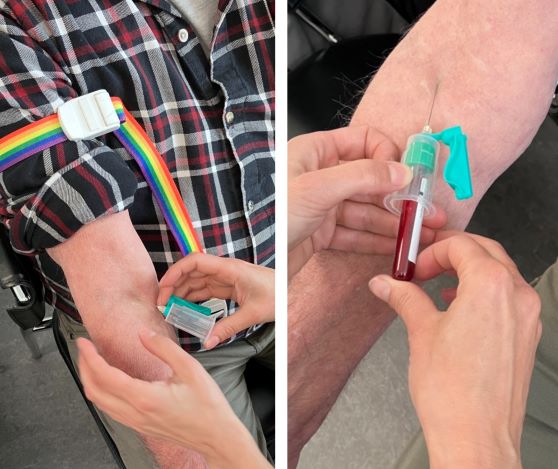 Arm med stageslange på. Kanyle med blodprøveglas, der tages en blodprøve.