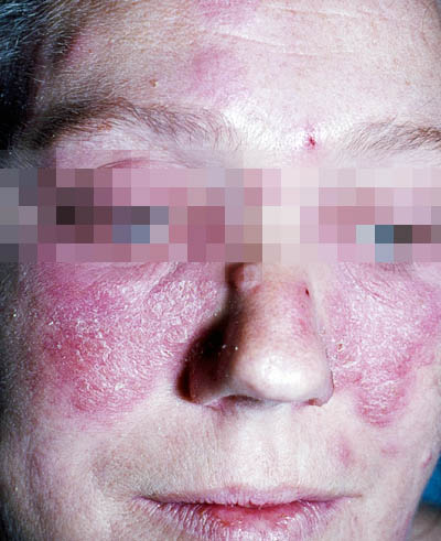 Sommerfugleeksem ved Lupus