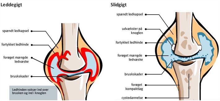 Leddegigt, slidgigt