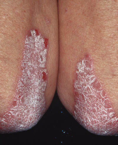 Psoriasis på albuer