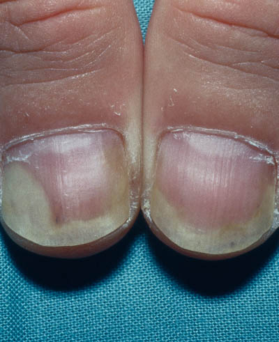 Psoriasis, negle der løsner sig