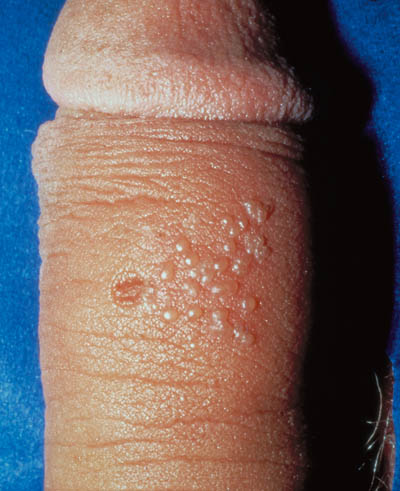 Blærer på penis ved udbrud af herpes
