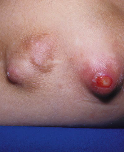 Urinsyregigt