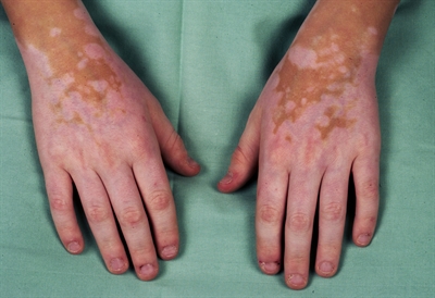 Vitiligo på hænder