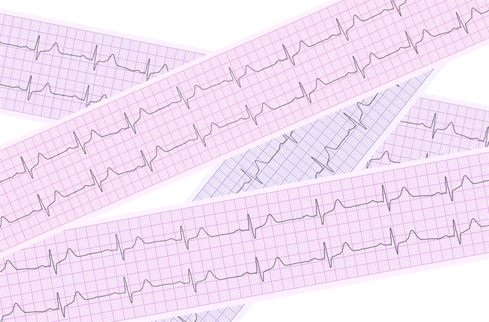 EKG på flere strimler.