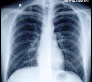 Røntgen af thorax